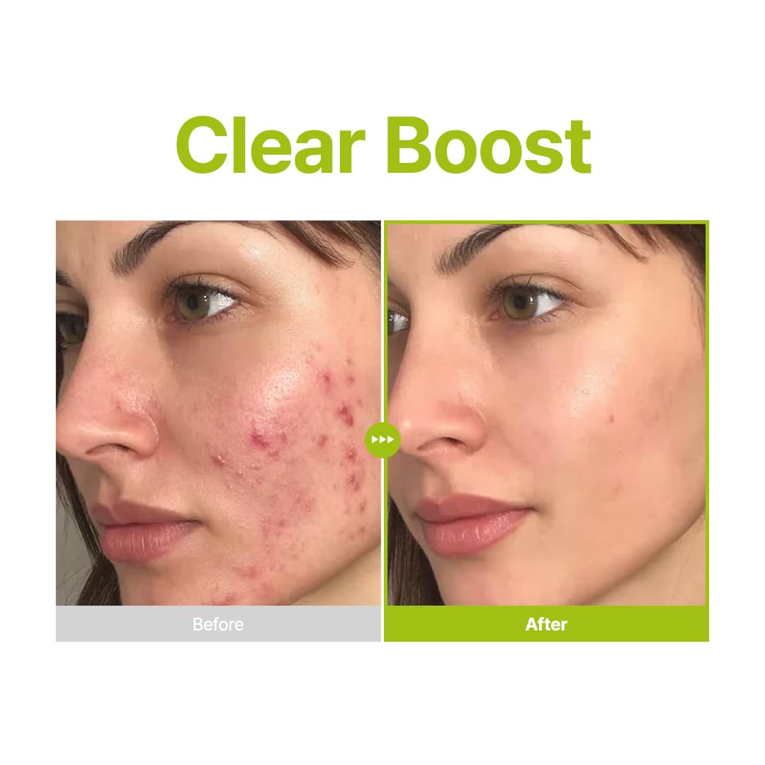 Azelaic Acid 10 Kojic Tea Tree Serum