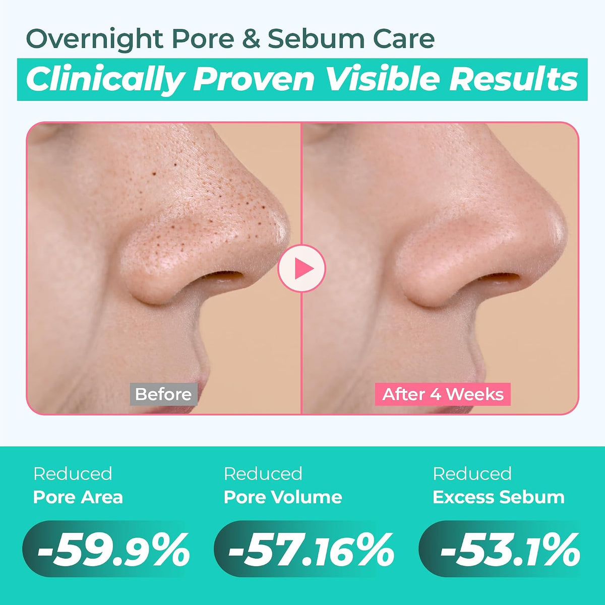 Overnight Zero Pore Nose Patch – Επιθέματα Μύτης Νυκτός για Πόρους & Λιπαρότητα