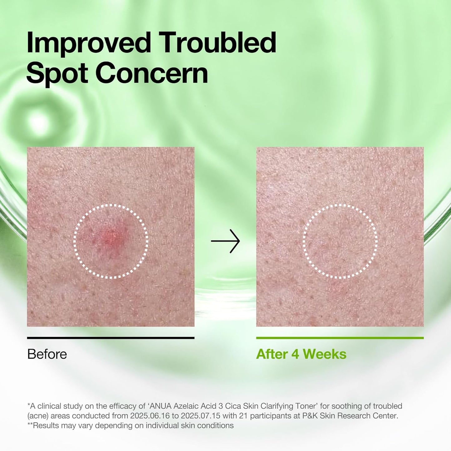 Azelaic Acid 3 Cica Skin Clarifying Toner - Καταπραϋντική Τονωτική Λοσιόν για Ευαίσθητη & Ακνεϊκή Επιδερμίδα